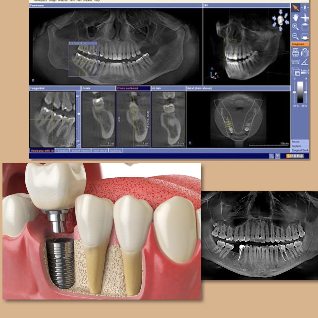 имплантат зубов фото